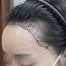 장헤어라인 이미지