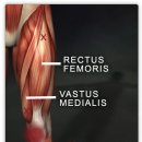 Rectus femoris AND VASTUS MEDIALIS 이미지