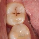 구월의치과의원 | 간석동 충치치료 꼼꼼하게 진단하고 치료해드린 구월의치과 후기