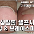 이엠아이코리아 | [셀프네일]내성발톱 셀프시술 역핀칭 &amp; 브레이스띠 붙이기