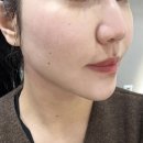 삼성 | 강남 티타늄 리프팅 W클리닉 삼성점 후기 4만줄 리얼 체험