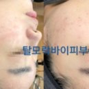 탈모락바이피부수작 네이버블로그
