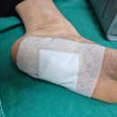 성모SK마취통증의학과 | 발바닥 점 빼기 점 제거 후기 (매우 아픔 주의)
