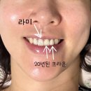 강남역 치과 라미네이트 후기 | 크라운 교체 비용과 과정, 만족도 솔직 리뷰