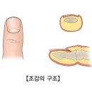 생인손 ㅡ 조갑주위염(Paronychia) 이미지