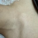 화중로 | 재방문 후기) 고양 일산 화정 내돈내산 목, 가슴, 등 편평사마귀 케어 [글로우업뷰티]