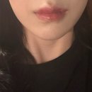 필러 | 입술필러후기 내돈내산 쥬브겔후기 (붓기,멍,경과) 리얼후기