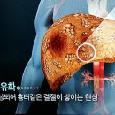 간경변증,간 섬유화 이미지