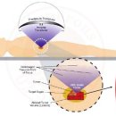 집속 초음파 치료[high intensity focused ultrasound] 이미지