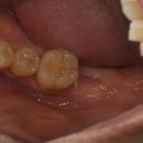 연세대야S치과의원 | 어금니 충치 뿌리 통증 아픔, 치아 발치 후 네비게이션 임플란트 후기