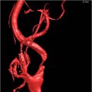 뇌경색 - 내경동맥 협착의 스텐트 삽입수술 이미지