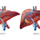 간암의 양성종양과 악성종양 이미지