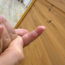 수완병원 | 17개월 아이, 가열식 가습기 화상으로 인해 광주 수완지구 화상병원방문 후기