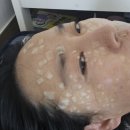 천지한의원 | 지긋지긋한 편평사마귀 제거 구리 올바디한의원 한약복용 후기