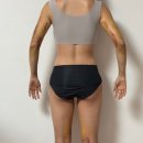 어머멍 | [허벅지람스+팔뚝살람스+허파고리]당일+7일 사진 후기/멍,붓기,람스통증 및 주위사항 일상생활 가능...