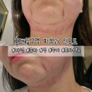 멍분의 멍 | 홍대피부과추천 인모드 멍 부작용 일주일 개선후기