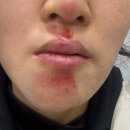 선사은피부과의원 네이버블로그