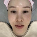 리쥬란힐러,눈밑실,아이리쥬란후기,안단테레이저