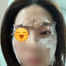 아름다운약국 | 편평사마귀 제거 일주일후기 포항 아름다운피부과 내돈내산