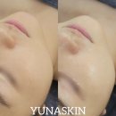 [공지] [유나스킨]송도피부관리 셀디치톡스 탄산케어로 톡톡터지는 상큼한 피부 만들기 / 피부조명버튼...