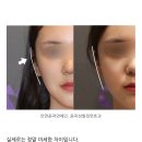 ㅁㅊ 안면윤곽 전후 보는데 존나 싣기함 이미지