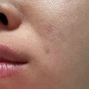 에스와이바른피부과의원 | 광주 피부과 스킨부스터 리쥬란 힐러 2cc, 물광주사 가격 /엠보, 통증 (내돈내산 후기)