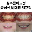함께웃는치과교정과치과의원 | 설측교정 치과, 비대칭 재교정 – 투명교정 실패 후 콤비교정으로 개선 후기