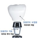 목천자연치과 - 임플란트보철 회복 후기