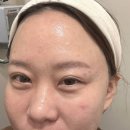 중원메디칼 | 성남피부관리 추천 금광동 뷰티피아트 물방울 리프팅 후기