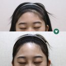 헤어라인제모 깔끔한 후기 (3자/m자, 좁은이마)