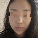 얼굴 전체 잡티 빼는 시술 후기. 미앤지의원. 스레드 보고 간 후기 4/29일 방문 /통증.후관리.회복까지...