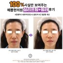 대전중안부리프팅 얼굴실 테스리프트 장점&amp;동안 효과 , 내돈내산후기