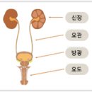 요로결석이란? 이미지