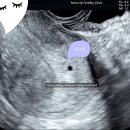 서울산부인과의원 | 서울 아이앤여성의원 졸업 후기 -