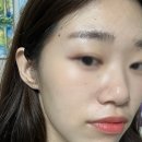 케이트의원 | 홍대 피부과 포텐자, 더마샤인 쥬베룩으로 모공관리 솔직후기
