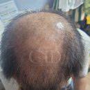 광주 대머리 삭발두피문신 잘하는 곳 채움 스튜디오 아카데미 광주