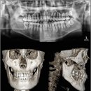 이유구강악안면외과치과의원 | 윤곽3종수술 후기 수술방법 내돈내산 구강안면치과