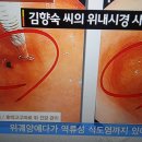 위궤양,역류성 식도염에 호박고구마,치유사례 이미지