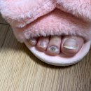 르사(LSA) | 내성발톱 자가치료 확실한 해결방법