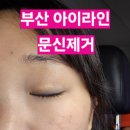 친절한푸른약국 | 부산 아이라인 문신제거 연산동 피부과에서 10년된 문신지우기 1회차