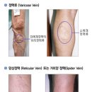 정언섭맥의원 | [부산하지정맥/부산하지정맥치료후기] 부산 정언섭맥의원의 하지정맥치료후기 입니다.
