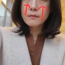 신논현역피부과 눈밑꺼짐에 효과적인 미희콜라겐주사 실제 후기