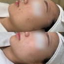 이유앤스킨 | 포항 여드름 관리 잘하는 곳 찾는다면 👉🏻 “이유앤스킨” 내돈내산 후기🧴