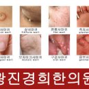 사마귀란? 발바닥 얼굴 사마귀 제거 방법 종류 연고 베루말 에스로반 이미지