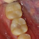 우면프라자 | 치과] "씹을 때마다 깜짝 놀라게 아파요" 충치 없는 어금니, 큐레이(Q-ray)로 찾아낸 금(Crack) 치료 후기