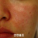 아크네마인드의원 | 아크네마인드에서 알려드립니다. 안면홍조와 여드름자국이 어떻게 다를까?