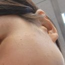 해모수한의원 | 비립종 2개 제거하려다가 사마귀 40개 제거한 후기