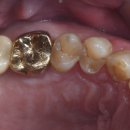 네오치과의원 | 당일 임플란트 어금니 발치 즉시 식립 가능한 경우, 후기