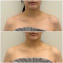 씨제이올리브영(주) 광주효천지구점 | [광주에스테틱] 서화에스테틱 :: 승모근 라인까지 같이 예뻐지는 윤곽관리