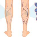 【하지정맥류】 자연히 낫는 일은 없다？ 되기 쉬운 사람의 특징은？ 이미지